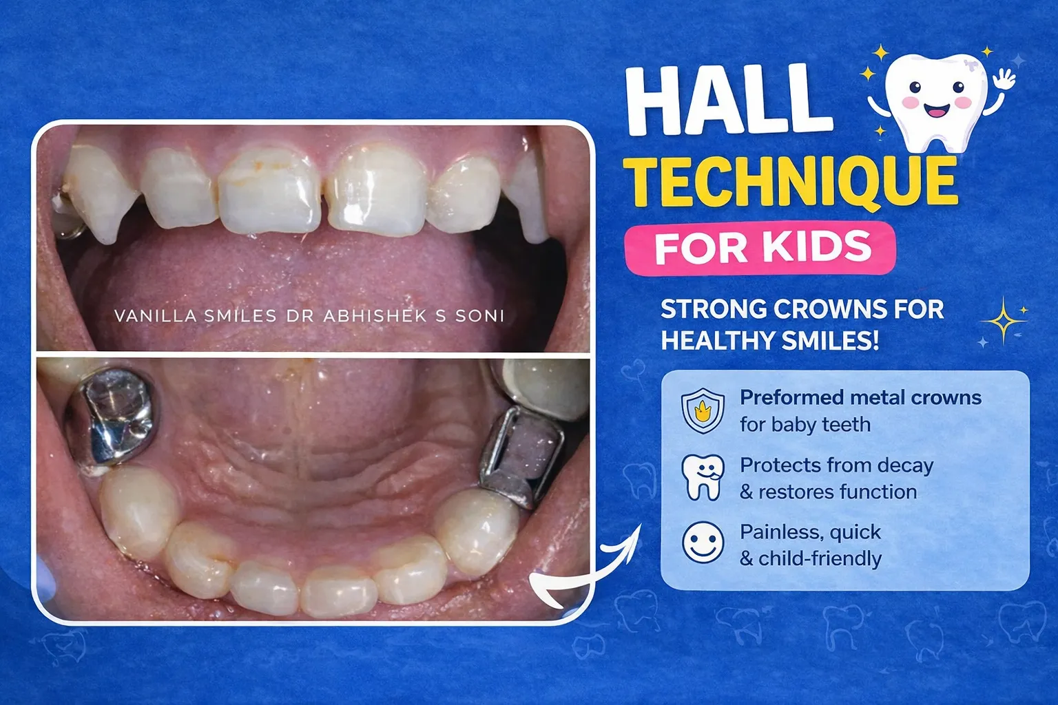 Understanding the Hall Technique: A Stress-Free Dental Treatment for Kids