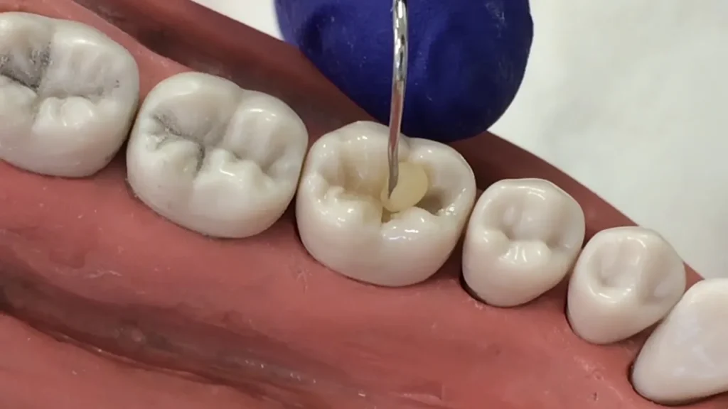 Composite Resin Fillings