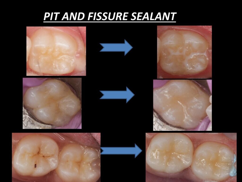 Dental Sealants