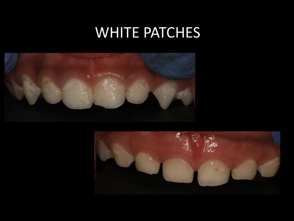 White Spot Lesions