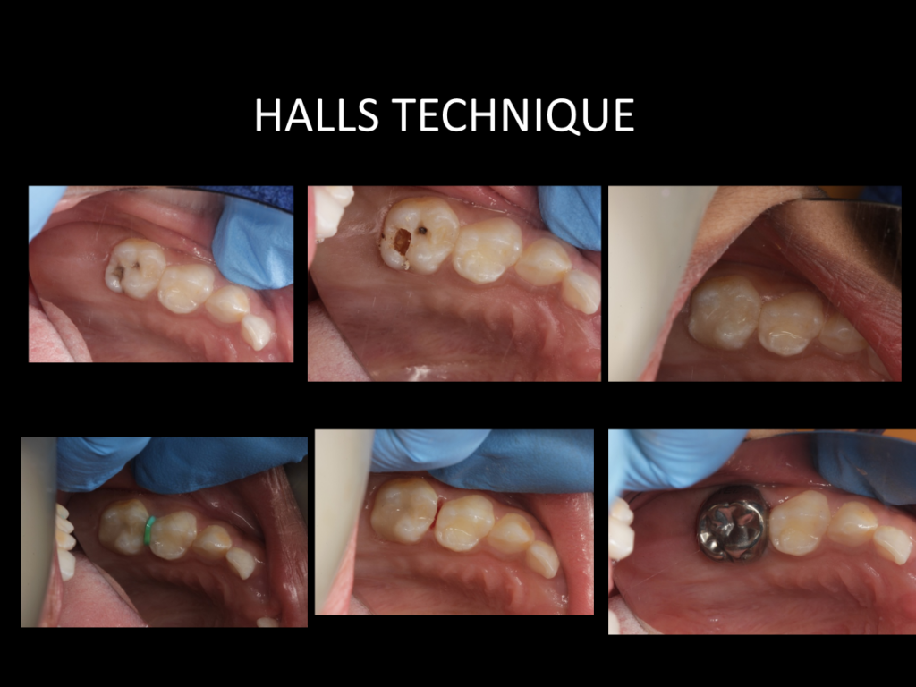 Hall’s Technique