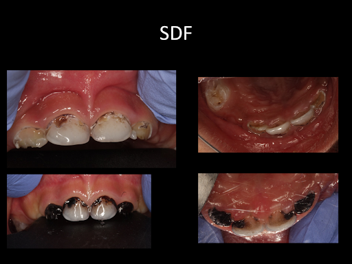 (SDF) Treatment
