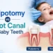Pulpotomy vs Root Canal