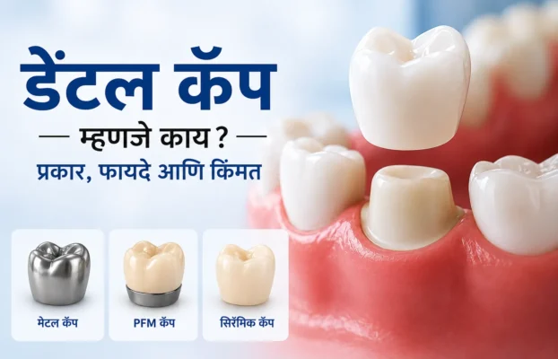 डेंटल कॅप (Dental Caps) म्हणजे काय? प्रकार, फायदे आणि किंमत
