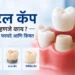 Dental cap