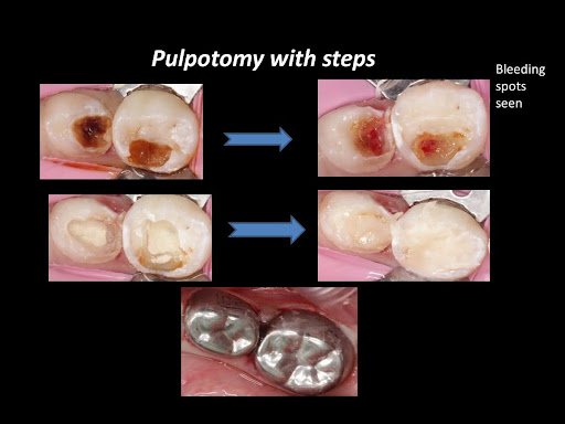 Pulpotomy