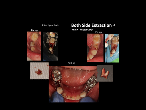 Dental Space Maintainer
