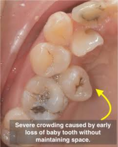 Crowded Teeth