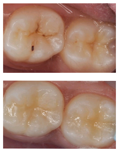 White Fillings