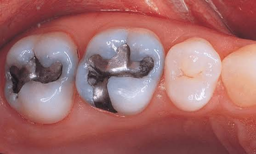 Silver Fillings