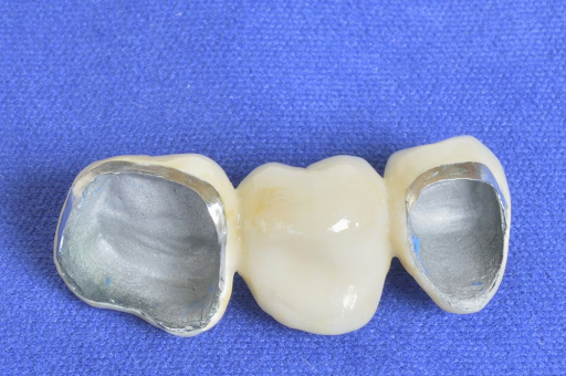 Porcelain Fused to Metal Crown