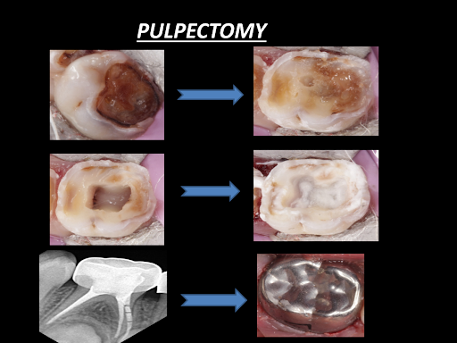 Root Canal in Baby Teeth