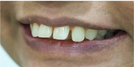 Teeth That Stick Out