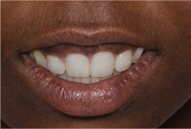 Difficulty Closing the Mouth