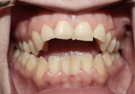 Teeth That Do Not Meet Properly