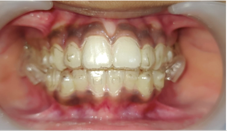 Invisalign for Child