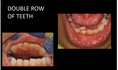 Difficulty Biting or Chewing