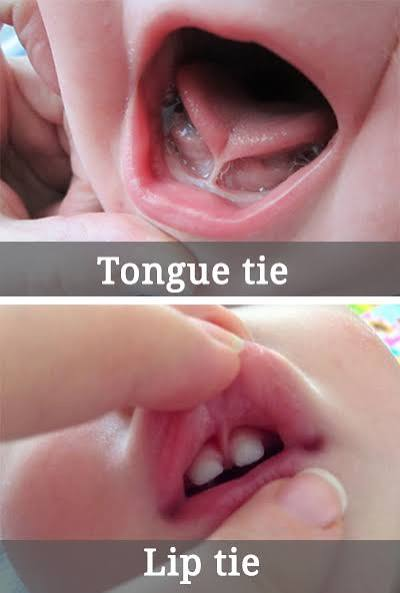 Tongue Tie or Lip Tie