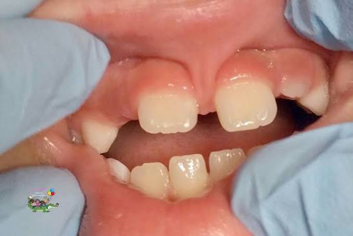 Gap between the upper front teeth caused by a lip tie