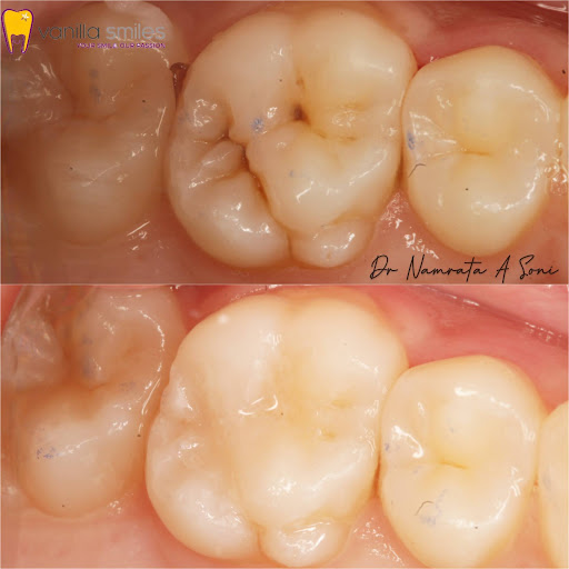 Dental Fillings