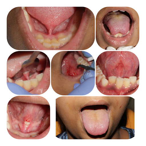 Laser Treatment