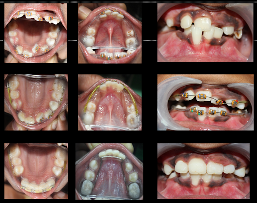 Orthodontic Care