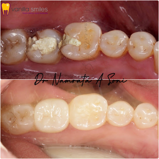 Dental Crowns