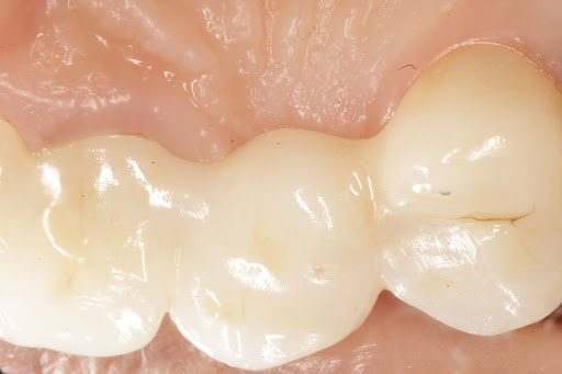 Dental Bridges