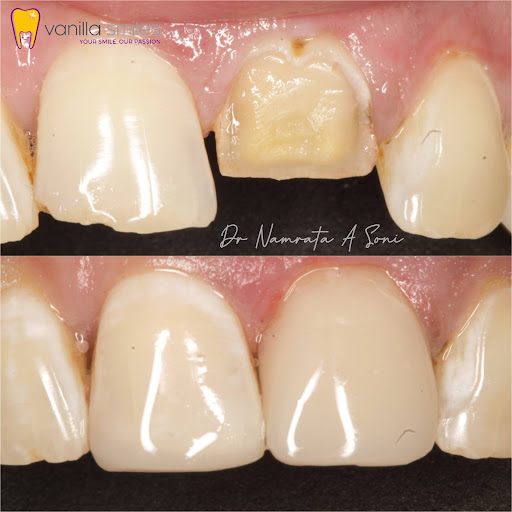 Tooth Structure