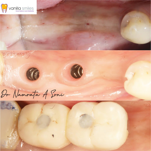 Dental Implants
