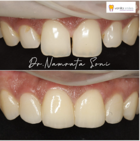 Discolored teeth