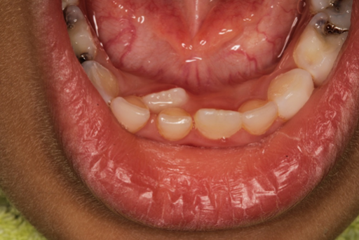 Tooth Extraction for Kids