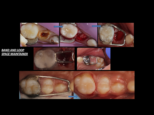 Tooth Extraction Performed in Children