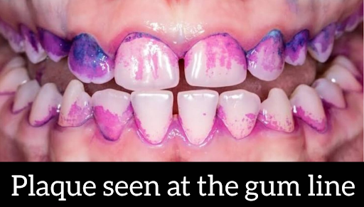 Dental Cleaning