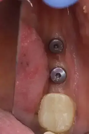 Dental Implants Dental Implants