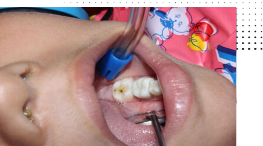 Tongue Tie Treatment in Deccan