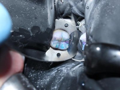 dental-caries3