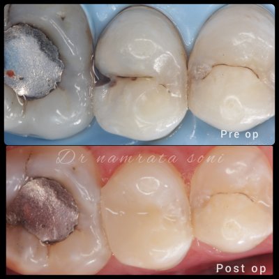 tooth-filling Best Dental Filling in Pune